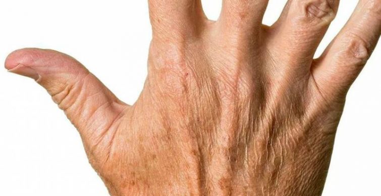Сухая кожа рук говорит о негативном влиянии на человека 